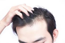 Simple home remedies to prevent hair loss  بالوں کے گرنے سے بچنے کے لیے آسان گھریلو علاج