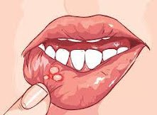 mouth ulcer treatment without medicines منہ کے السر کا علاج بغیر ادویات کے۔