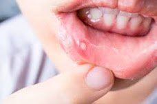 منہ کے چھالے Mouth Ulcer / Stomatitis Inflammation of Mouth ہومیوپیتھک علاج ایک بہترین اور مجرب نسخہ کے ساتھ