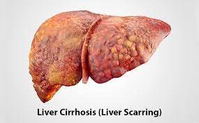 Cirrhosis of Liver and its Treatment