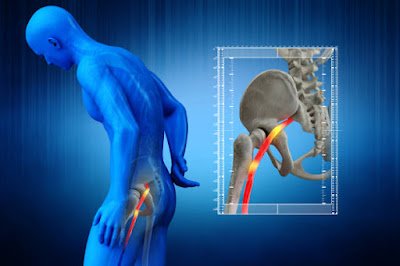 Sciatica Pain Homeopathic and Home Remedies Treatment