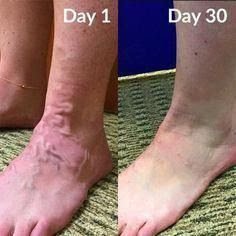 Varicose Veins Homeopathic Treatment